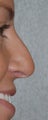 Rhinoplasty - Hump Reduction, Lift Drooping Tip