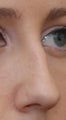 Rhinoplasty - Refine tip, Widen Dorsum