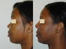 African American Rhinoplasty
