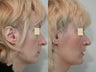 Rhinoplasty