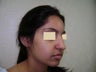 Rhinoplasty