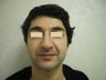 Rhinoplasty