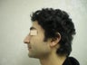 Rhinoplasty