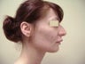 Rhinoplasty