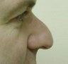 Rhinoplasty