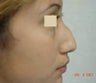 rhinoplasty
