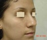 Rhinoplasty