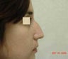 Rhinoplasty