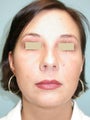 Rhinoplasty