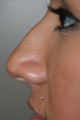 Rhinoplasty