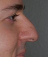 Rhinoplasty - Hump Reduction