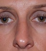Open Rhinoplasty