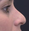 Rhinoplasty