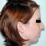 Rhinoplasty