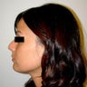Rhinoplasty