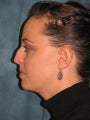 Rhinoplasty