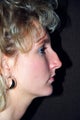 Rhinoplasty