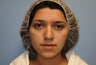 Rhinoplasty