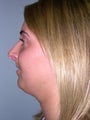 Rhinoplasty