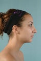 Rhinoplasty