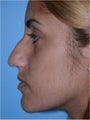 Nose surgery (Rhinoplasty)