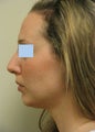 Rhinoplasty