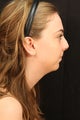 Rhinoplasty