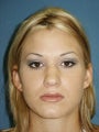 Rhinoplasty with sculpting of nasal tip and nasal dorsum