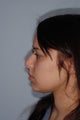 Rhinoplasty