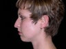 Rhinoplasty and Chin Implants