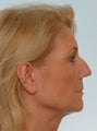 Rhinoplasty