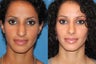 Rhinoplasty