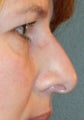 Rhinoplasty