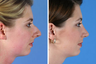 Rhinoplasty