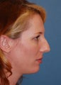 Rhinoplasty
