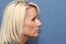 Rhinoplasty