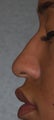 Rhinoplasty