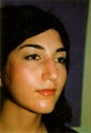 Rhinoplasty