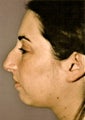 Rhinoplasty