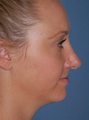 Rhinoplasty