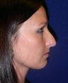 Rhinoplasty