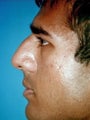 Rhinoplasty