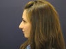 Rhinoplasty