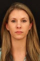 Rhinoplasty