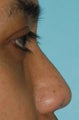 Non Surgical Rhinoplasty