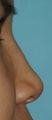Non Surgical Rhinoplasty