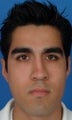 Rhinoplasty
