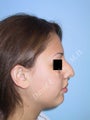 Rhinoplasty