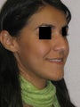 Rhinoplasty