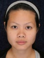 Rhinoplasty